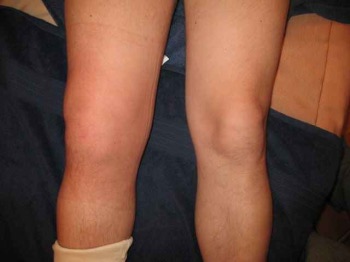 лечение артрита колена